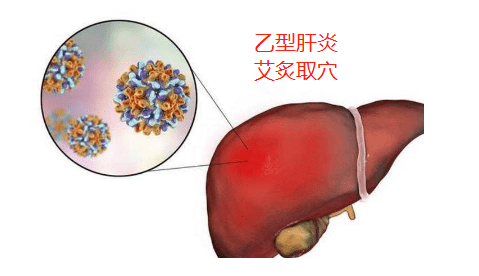 病毒性乙型肝炎艾灸取穴 