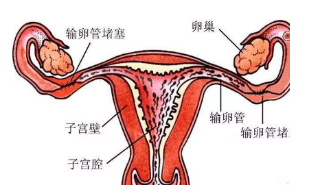 输卵管炎堵塞艾灸疗法穴位..