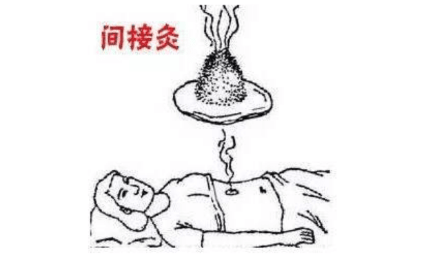 传统艾灸直接灸