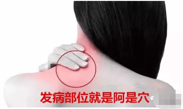 艾灸治疗痛风以灸痛点阿是穴为主