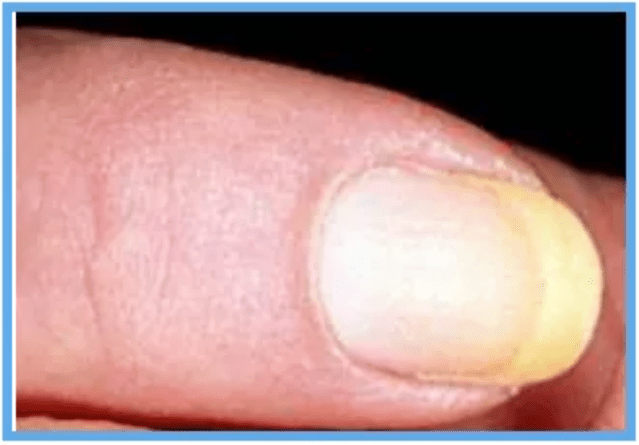 指甲类型诊断