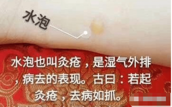 艾灸后皮肤起水疱 排病反应