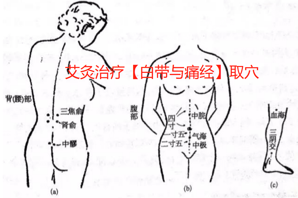 艾灸治疗【白带与痛经】取穴..