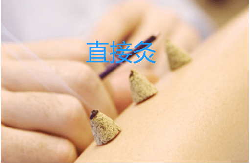 谢锡亮:直接灸法的应用..