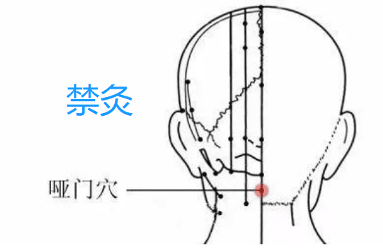 禁灸部位（穴位）有哪些？现代临..