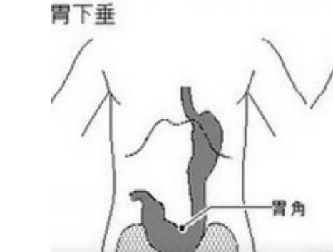 补元阳,中气升——【胃下垂】的..
