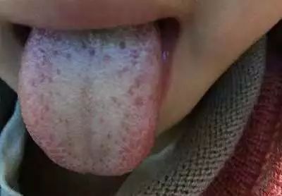 白厚的舌苔