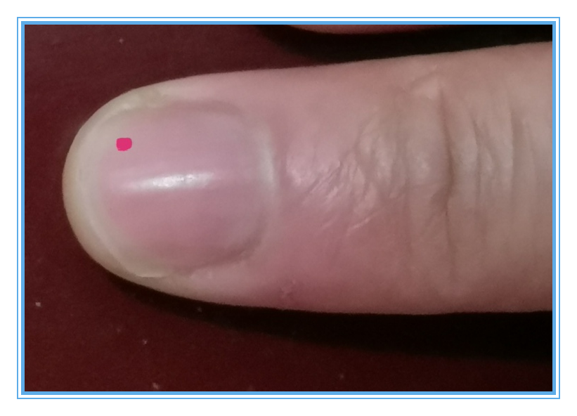 指甲诊断