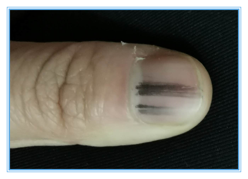 指甲类型诊断