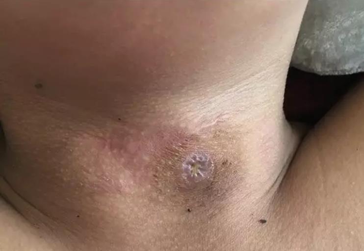 艾灸治疗疮疡溃口愈合